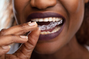 what is invisalign