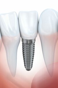 dental implants