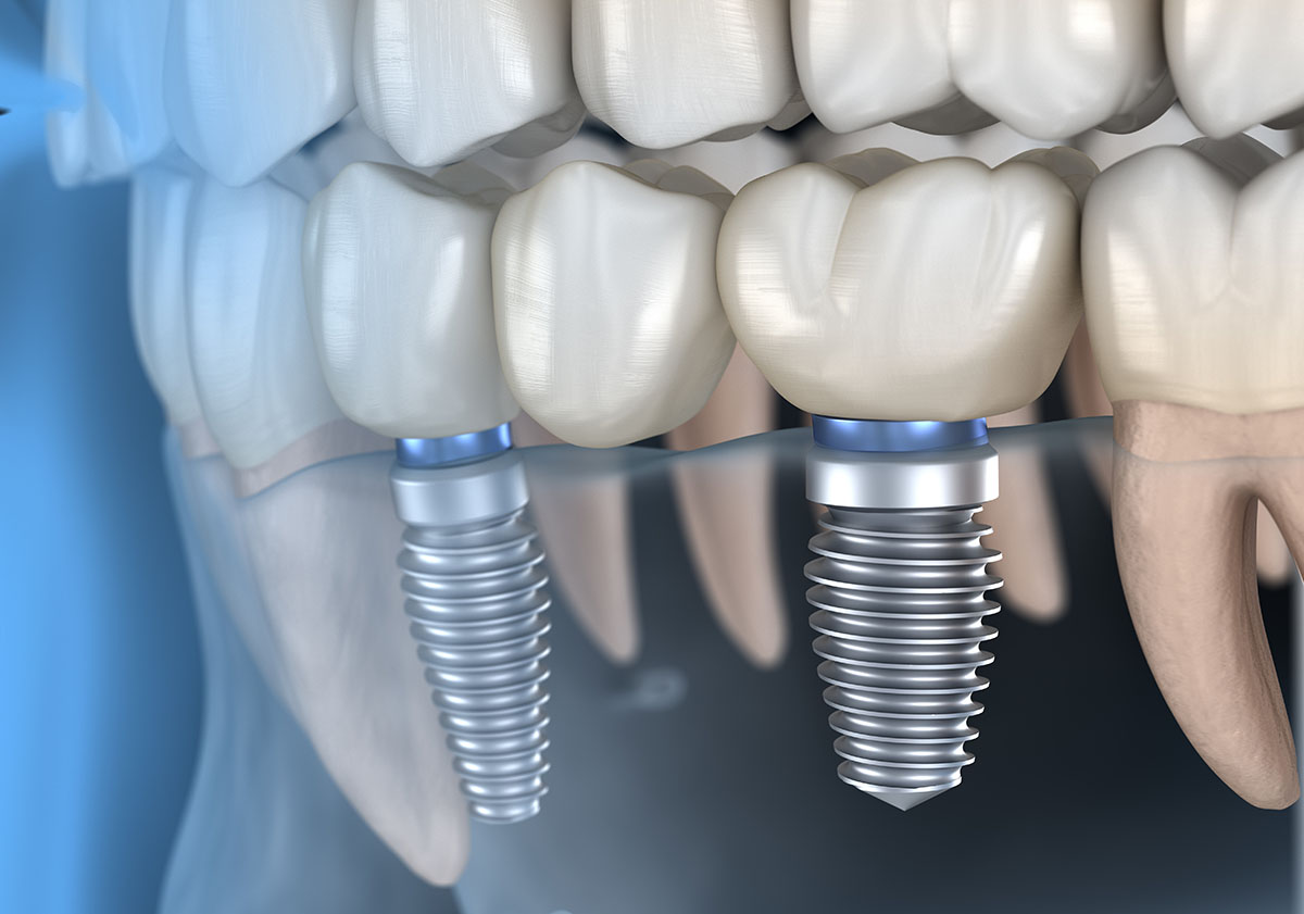 dental implant