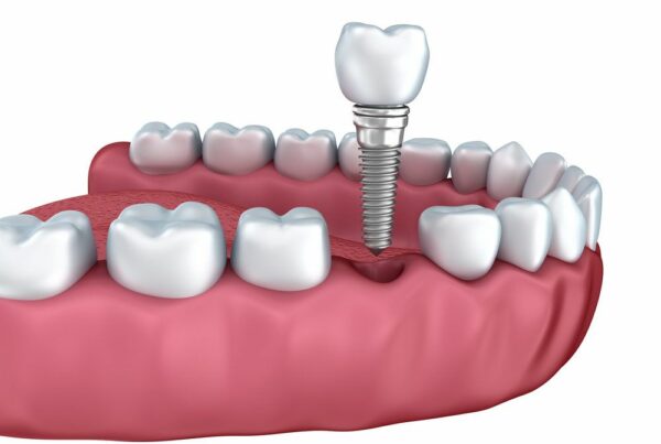 dental implant