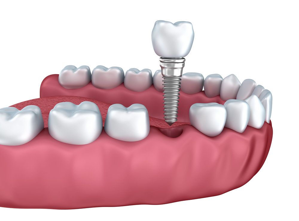 dental implant