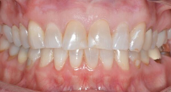 dental veneer results