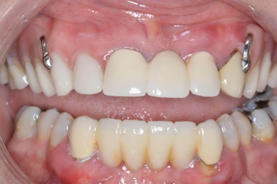 original hybrid denture before